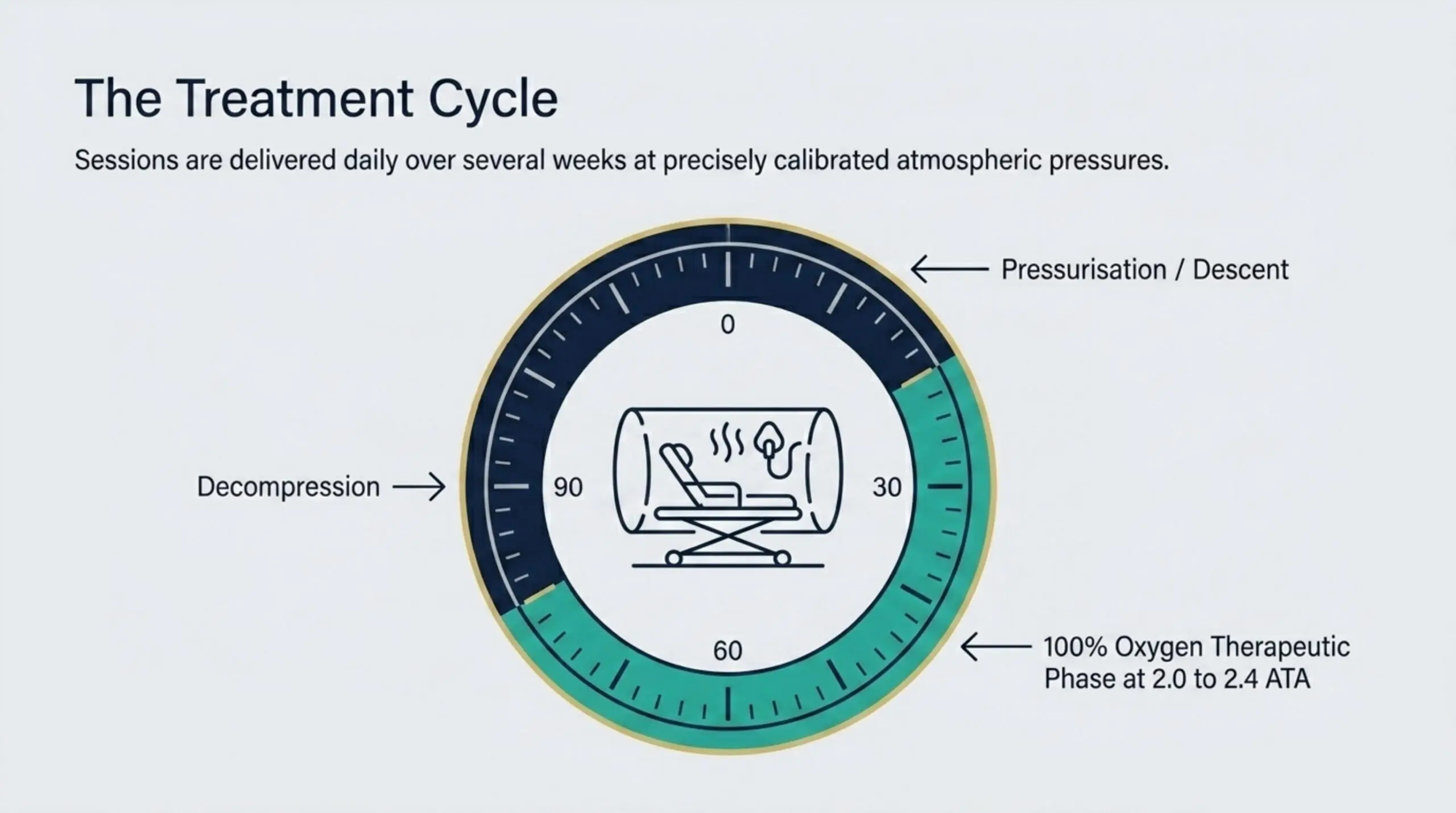 A hyperbaric session for radiation injury: pressurisation and descent, a 90-minute therapeutic phase breathing 100% oxygen at depth, then decompression, repeated on a weekday schedule.
