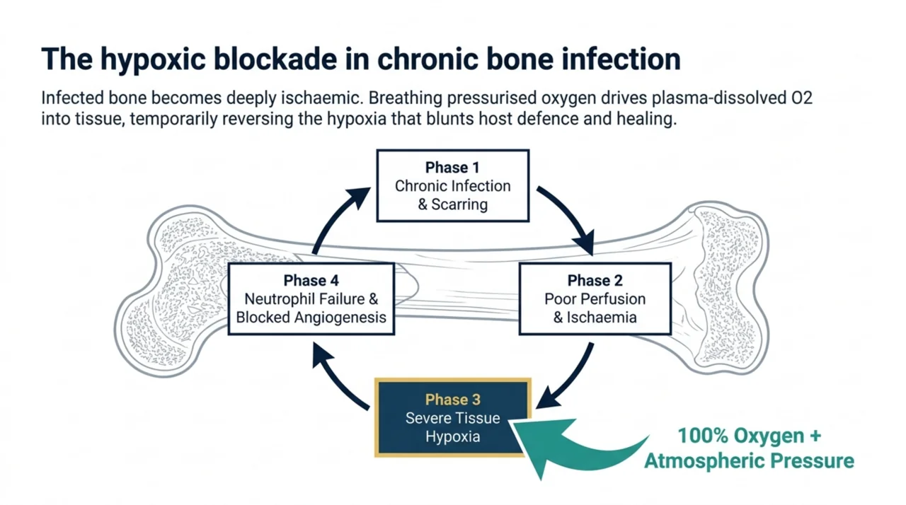 Diagram of the hypoxic cycle in chronic bone infection, where poor perfusion and tissue hypoxia blunt neutrophil function and angiogenesis while pressurised oxygen reverses the hypoxia