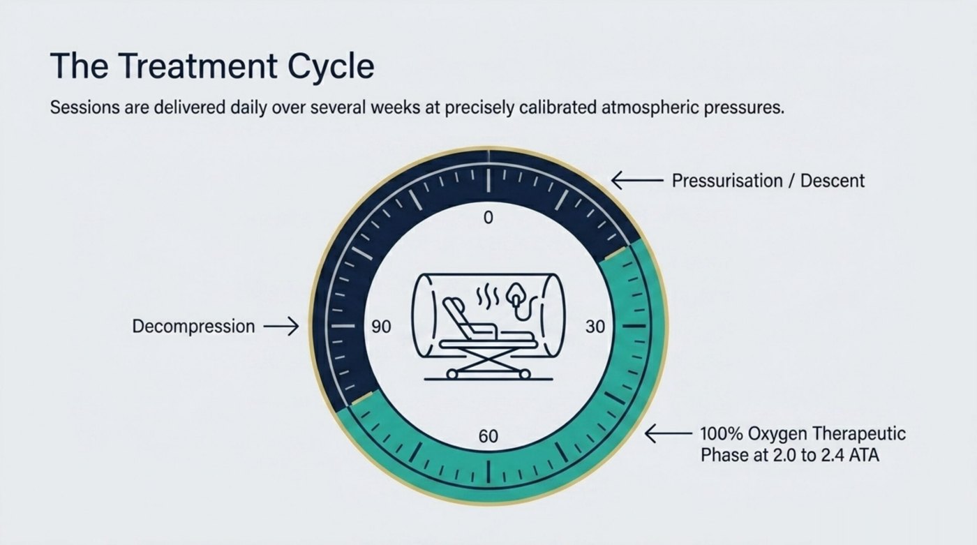 A hyperbaric session for radiation injury: pressurisation and descent, a 90-minute therapeutic phase breathing 100% oxygen at depth, then decompression, repeated on a weekday schedule.