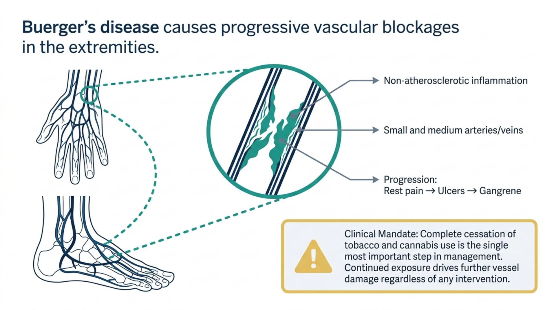 Diagram of Buerger's disease showing non-atherosclerotic inflammation of small and medium arteries and veins in the hand and foot, with progression from rest pain to ulcers to gangrene.