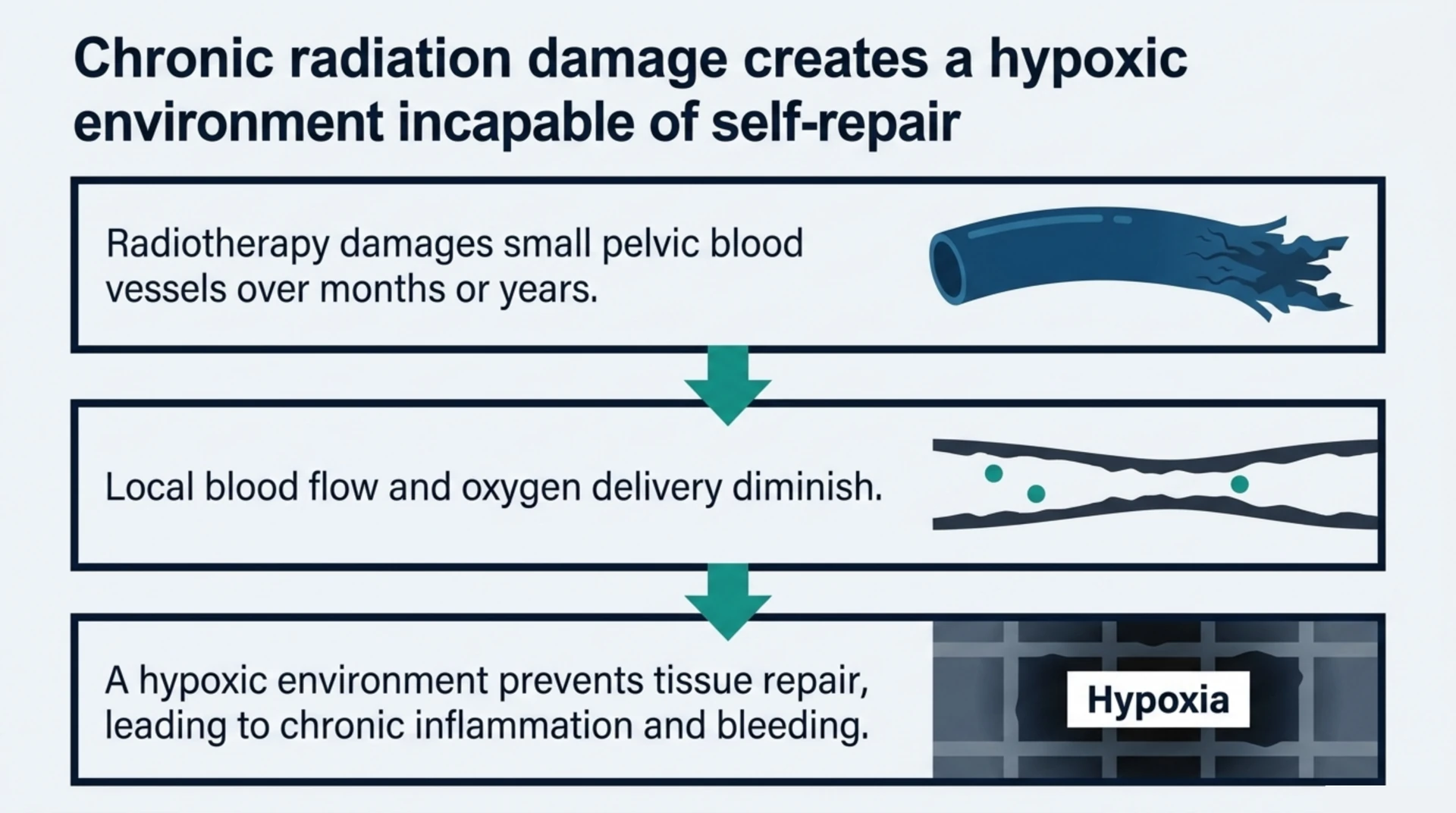 Three step diagram showing how radiotherapy damages small pelvic blood vessels over time, reducing blood flow and oxygen delivery and creating a hypoxic environment that prevents tissue repair.