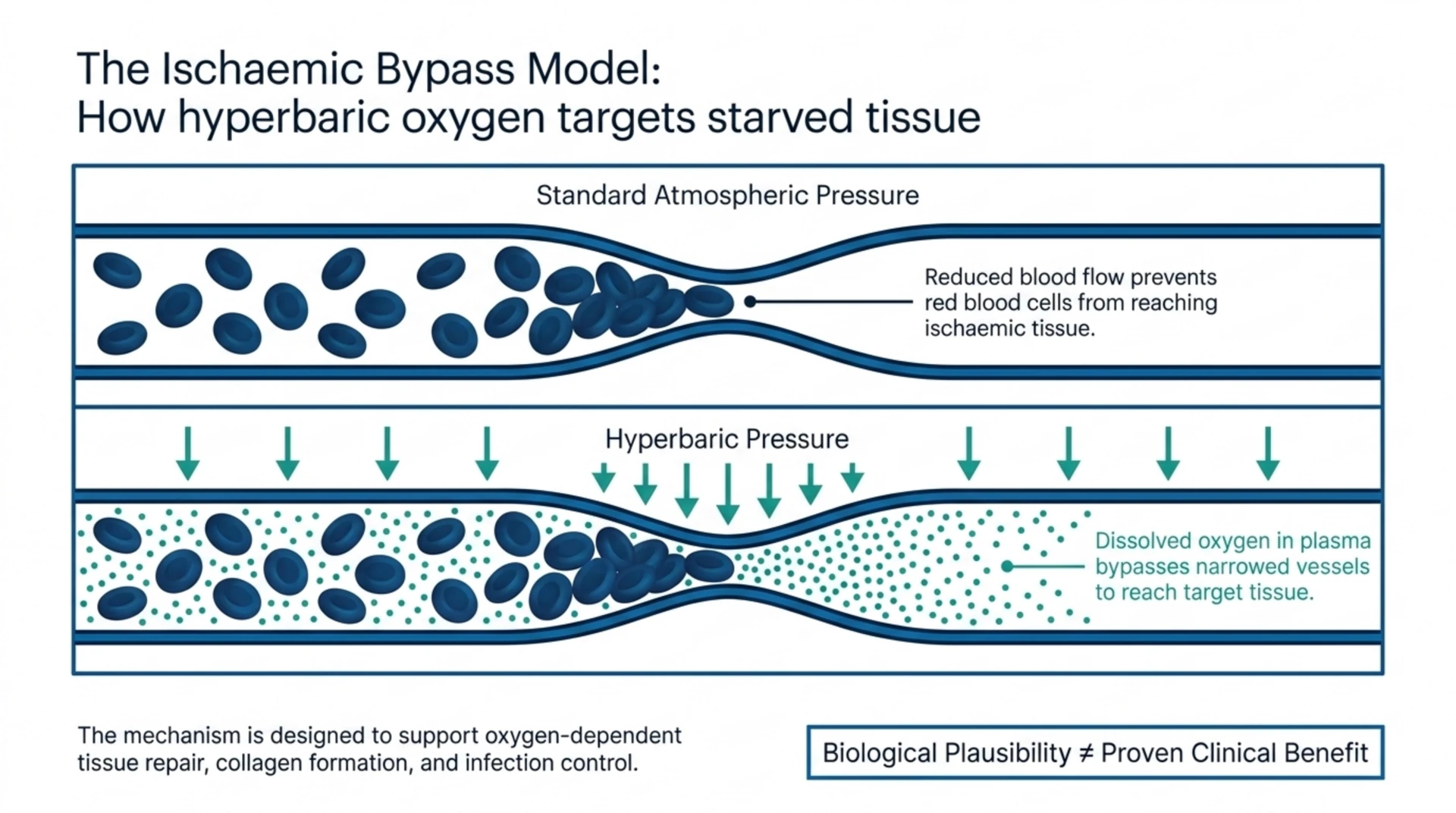 Diagram comparing standard and hyperbaric pressure, showing how dissolved oxygen in plasma can reach ischaemic tissue around narrowed vessels; biological plausibility is not the same as proven clinical benefit.