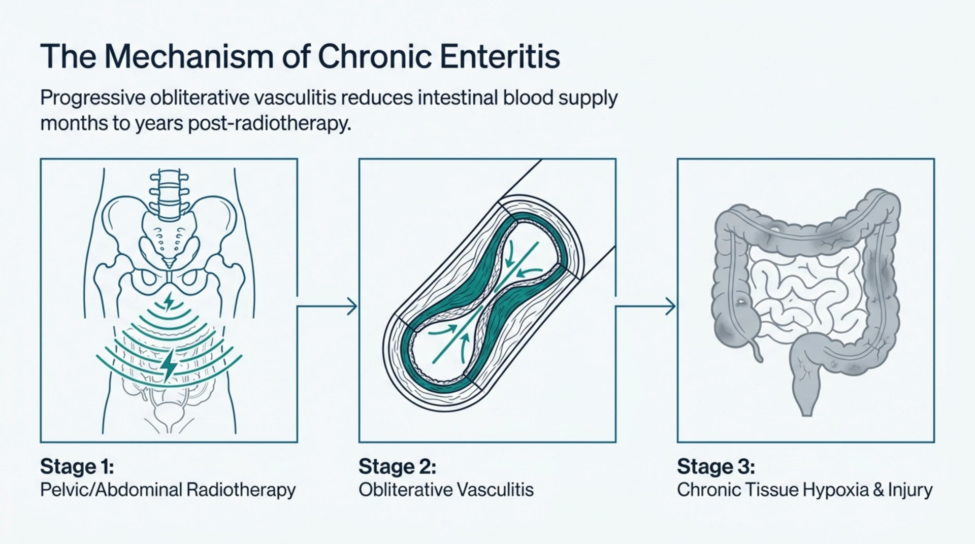 Diagram showing radiation enteritis progressing from pelvic or abdominal radiotherapy to obliterative vasculitis to chronic tissue hypoxia and bowel injury