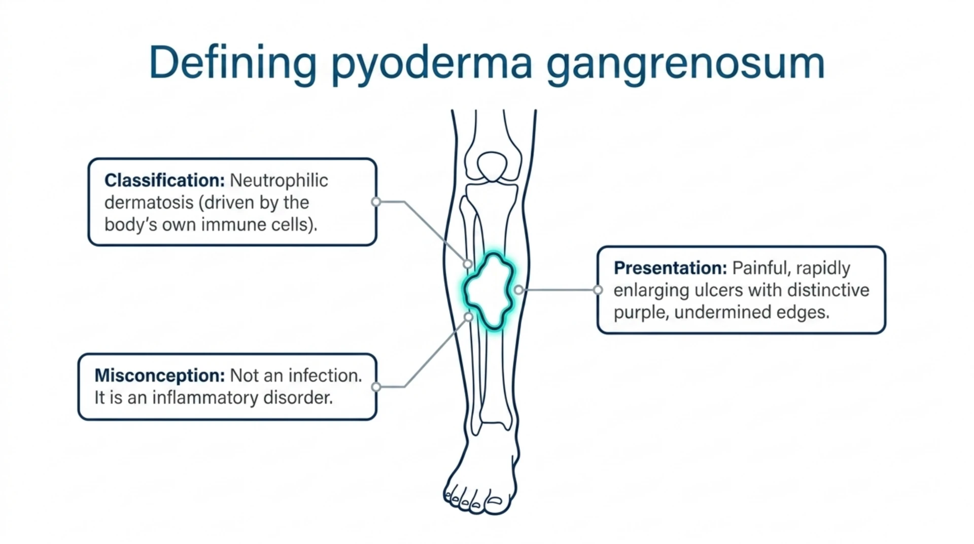 Diagram of pyoderma gangrenosum on the lower leg, showing its classification as a neutrophilic dermatosis and its rapidly enlarging ulcer with purple, undermined edges.