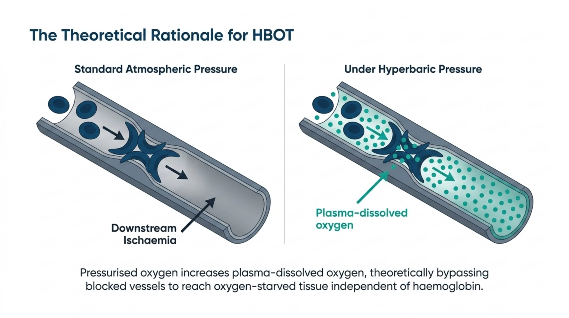 Diagram comparing blood flow at standard pressure versus under hyperbaric pressure, showing plasma-dissolved oxygen theoretically bypassing a blocked vessel