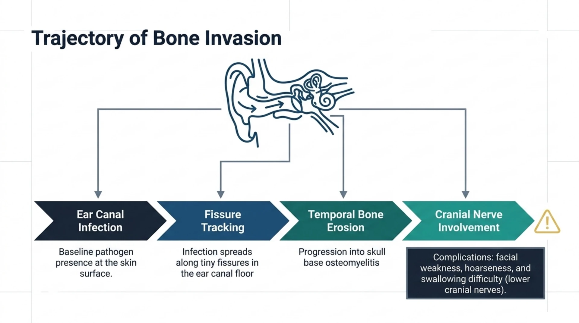 Diagram of malignant otitis externa progressing from ear canal infection through fissure tracking and temporal bone erosion to cranial nerve complications such as facial weakness and hoarseness.