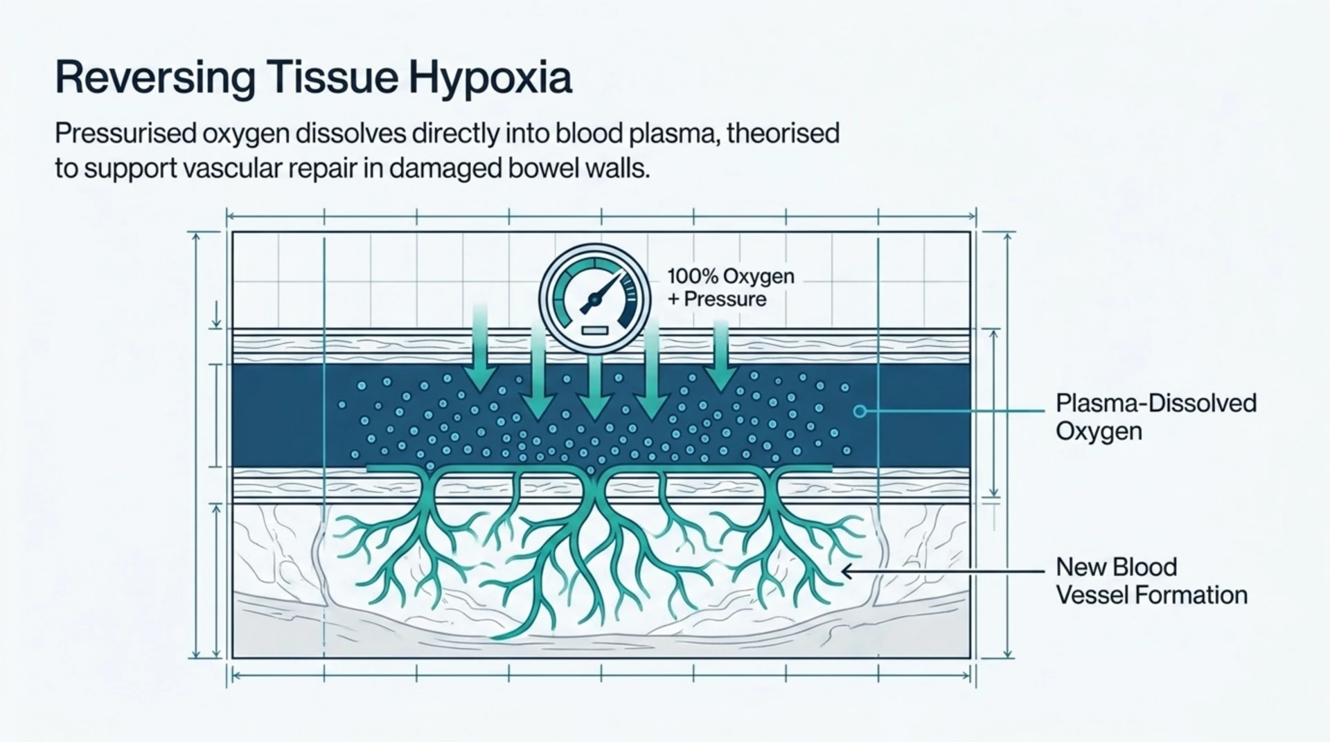 Diagram illustrating how pressurised oxygen dissolves into blood plasma under hyperbaric conditions, theorised to support new blood vessel formation in damaged bowel tissue