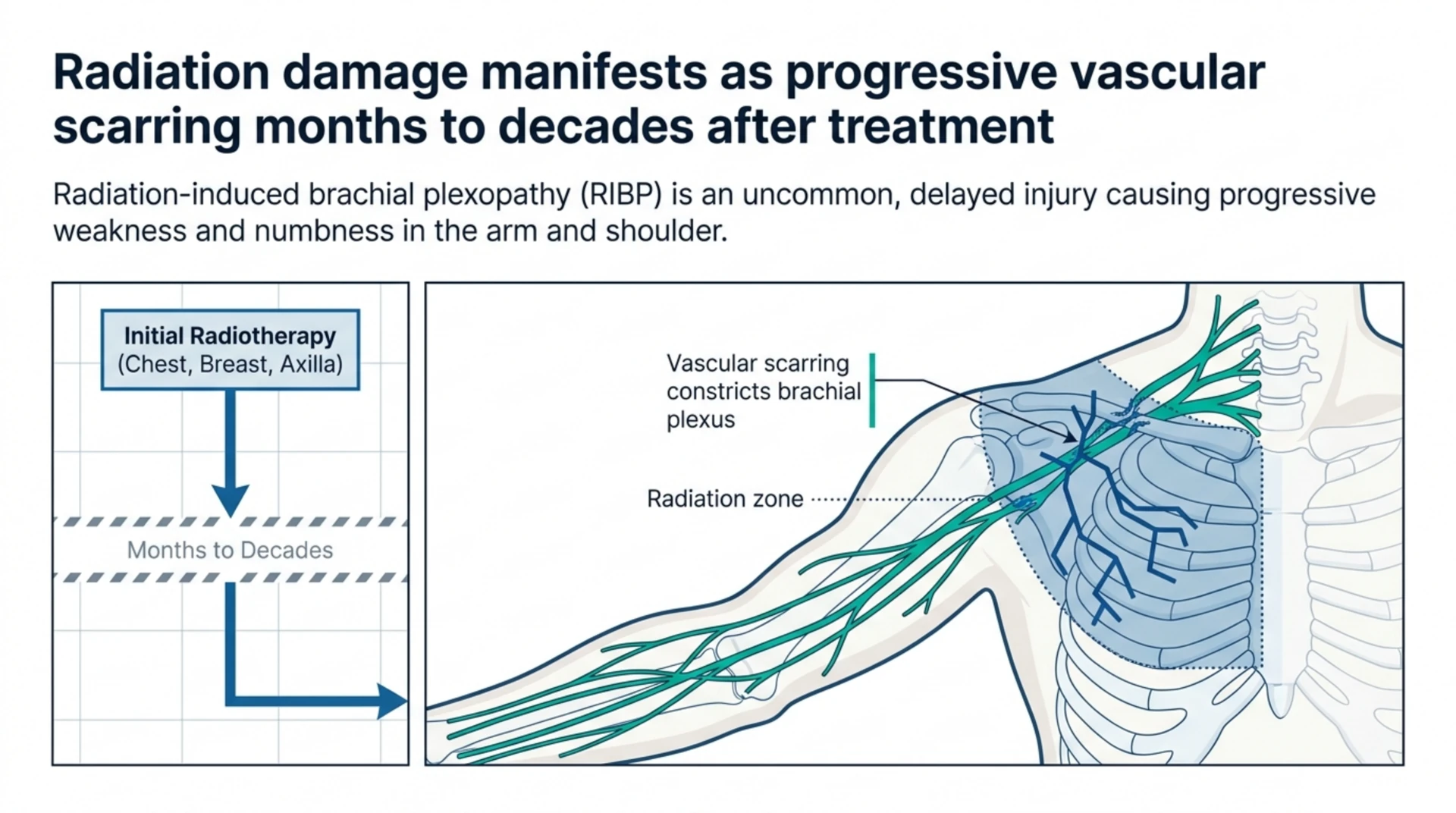 Diagram showing how radiotherapy-related vascular scarring develops around the brachial plexus over months to decades.